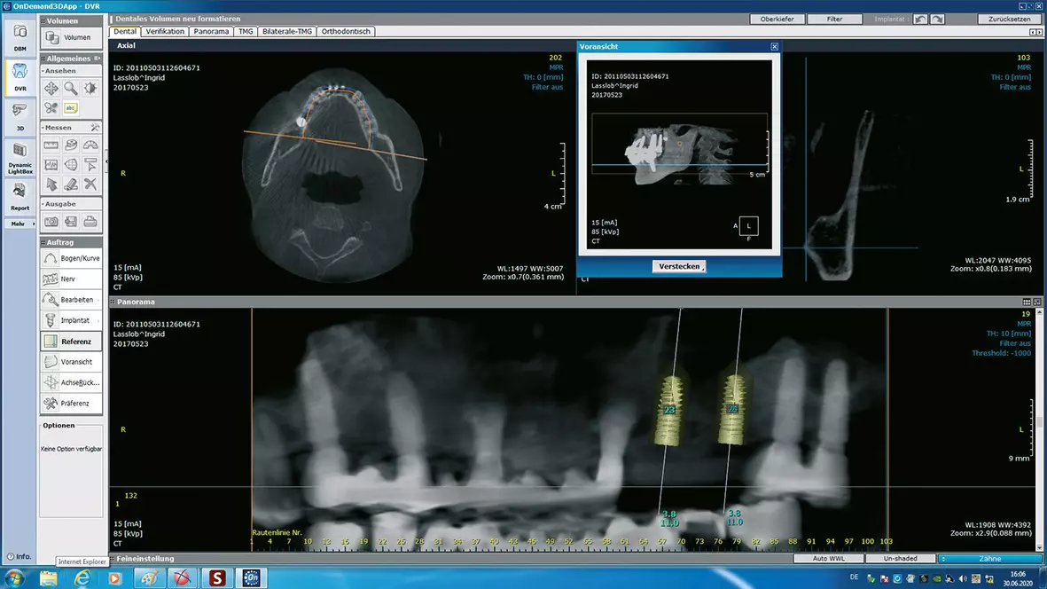 Abb. 7: Planung der Implantate und der notwendigen Augmentation im Sinus.