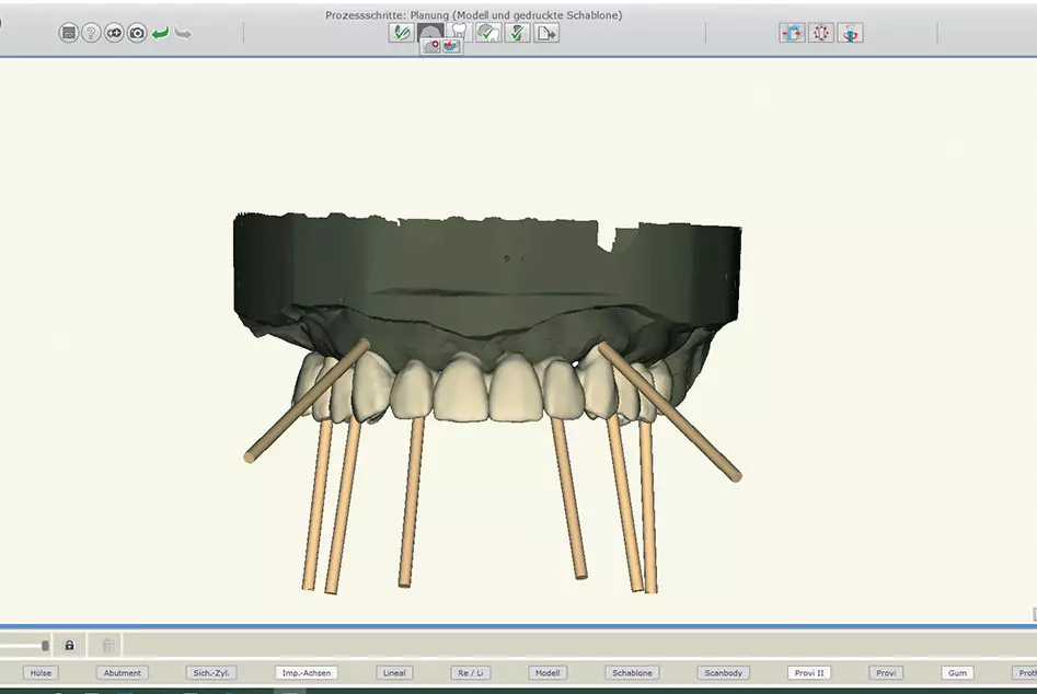 Abb. 10: Festlegung der Implantatpositionen.