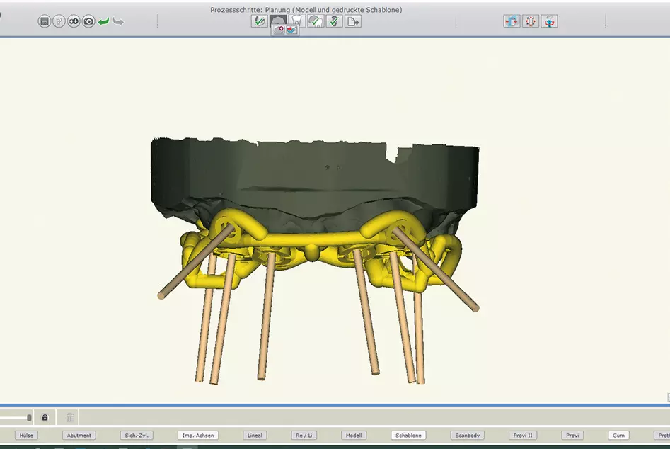 Abb. 12: Das virtuelle Schablonendesign.