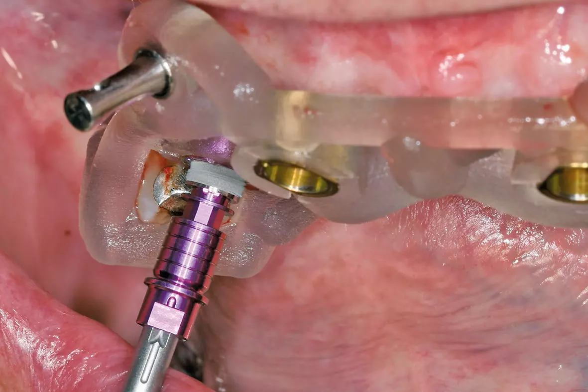 Abb. 17: Implantatinsertion nach protokollgerechter Aufbereitung der Implantatlager.