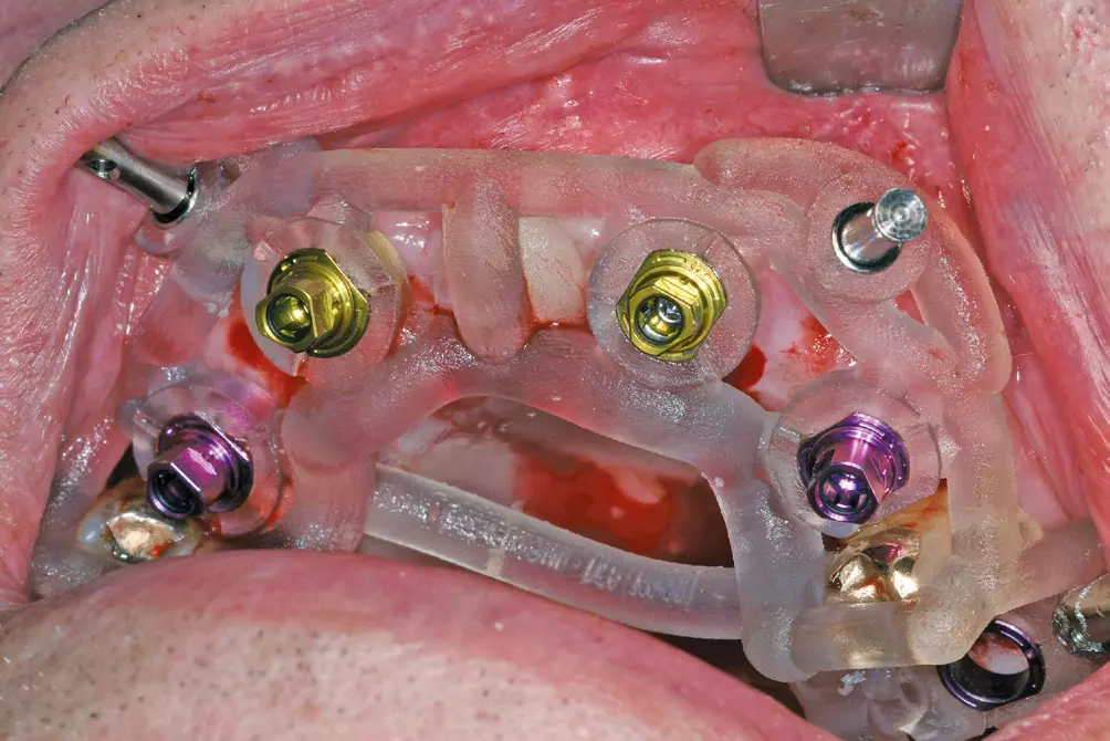 Abb. 18: Exakte Übertragung der Implantatposition in die klinische Situation.