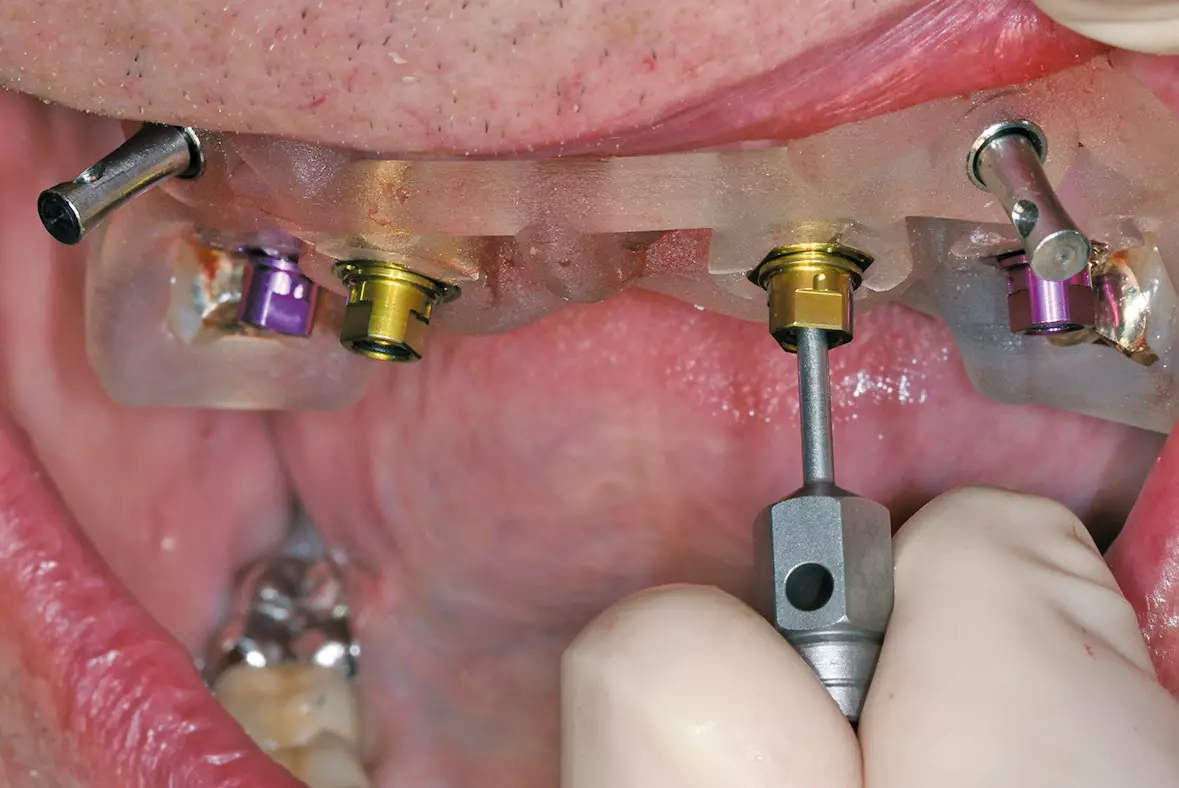 Abb. 19: Exakte Ausrichtung der Implantat-Innenkonfiguration.