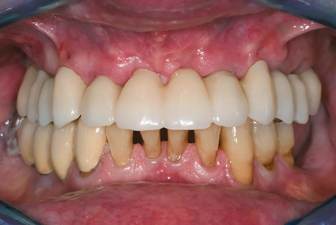 Abb. 26: Nahtentfernung nach einer Woche - reizfreie gingivale Verhältnisse mit beginnender Papillenausformung.
