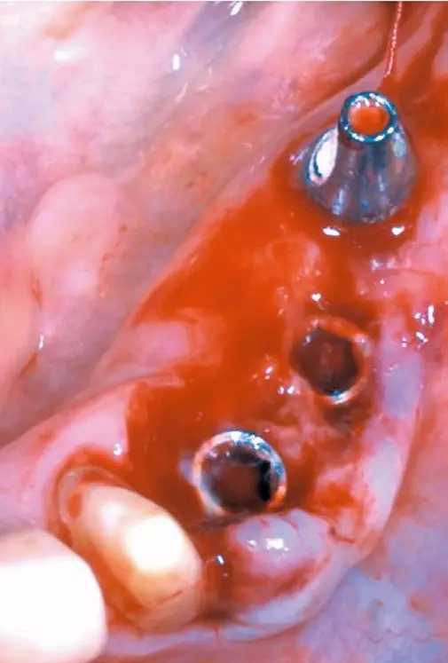 „Open Healing“ nach Explantation 34, Implantation 33+34 und Winkelmodulation.