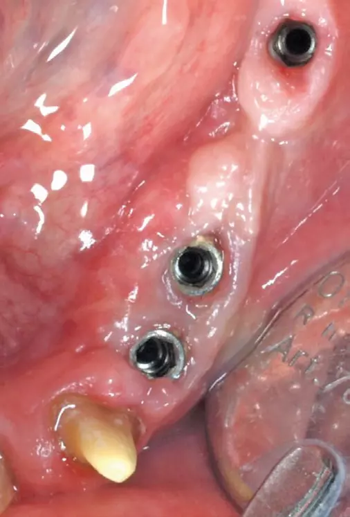 3 Monate post OP. Die Implantate tragen Gingiva-Shuttle.