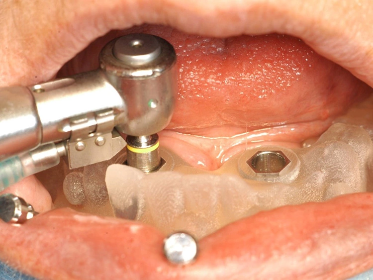 Abb. 11: Schleimhautstanze vor Präparation des Implantatbettes.