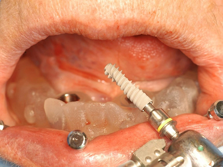 Abb. 13: Das ICX-Active Implantat.