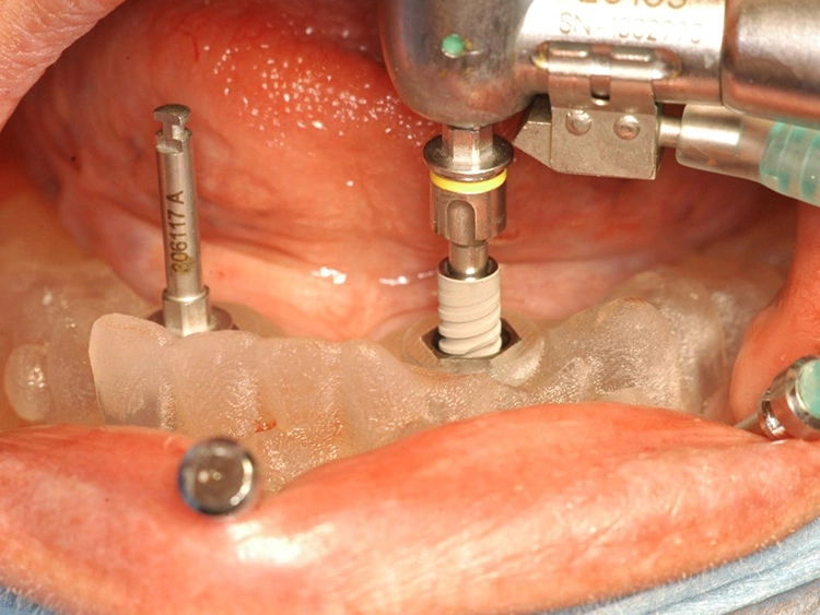 Abb. 14: Der Einbringpfosten zentriert das Implantat bei der Insertion.