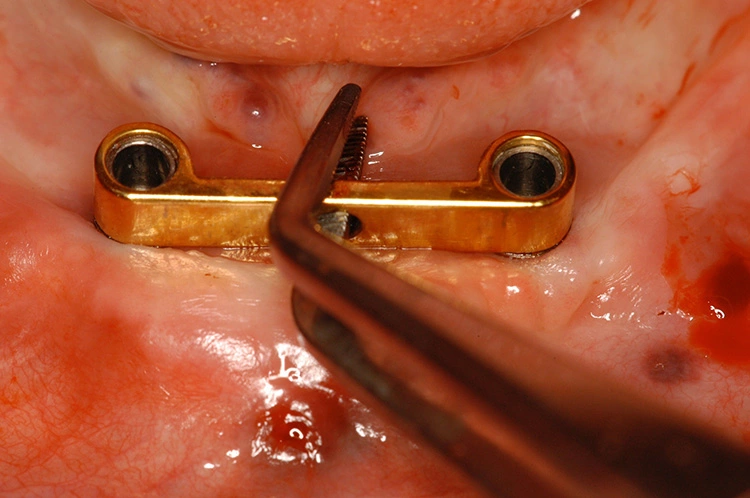 Abb. 16: Kontrolle der Insertionstiefe mit dem Steg.
