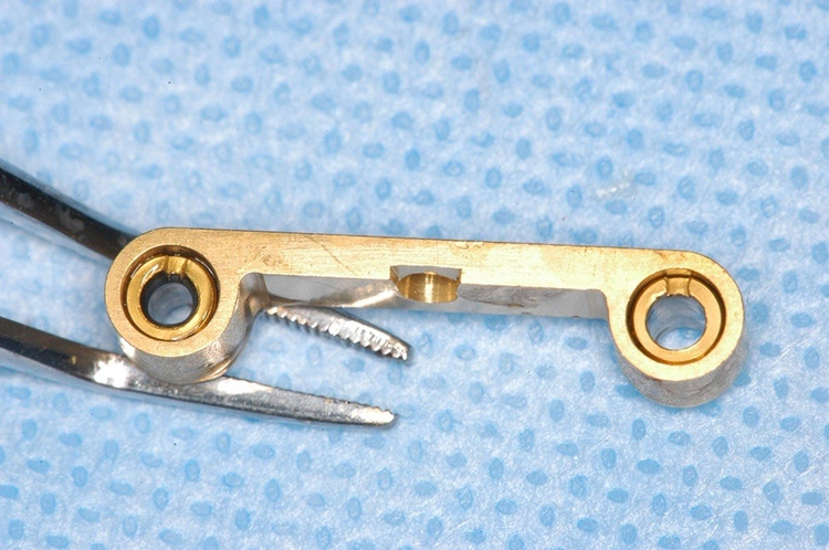 Abb. 18: Ausrichtung der „EBF“-Abutments nach vestibulär.