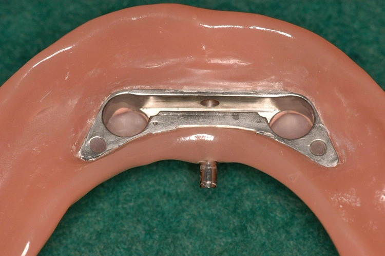 Abb. 24: Fertige Prothese mit integriertem Gehäuse.