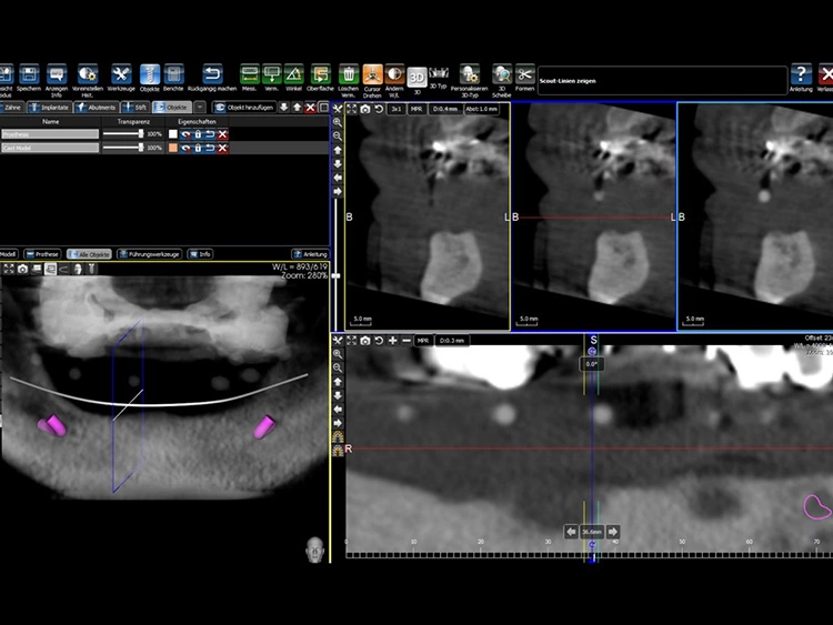 Abb. 5: DVT-Aufnahme des Patienten mit der Prothese.
