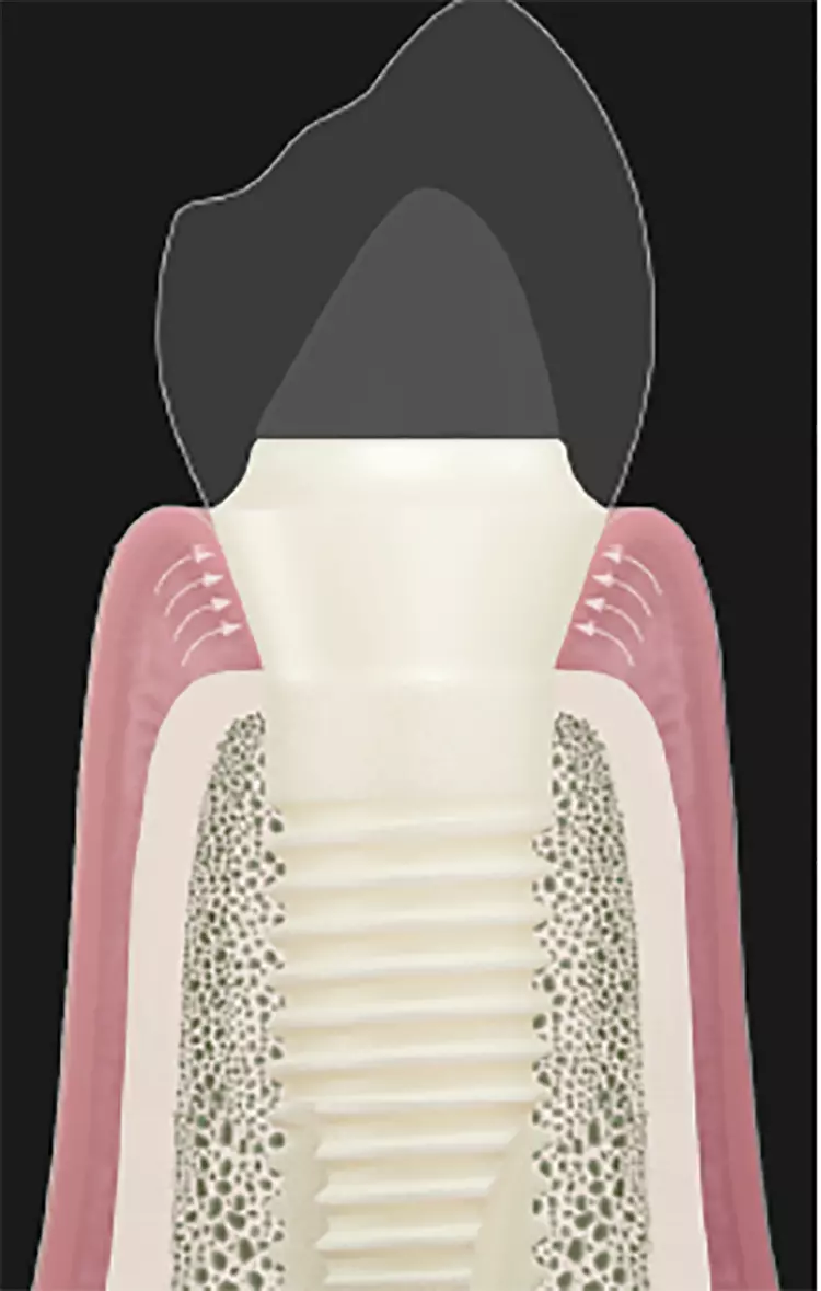 Abb. 1: Um inserierte Patent™ Implantate entsteht
ein starker Soft-Tissue Seal, der bakterielle
Erreger daran hindert, am Implantat vorbei in
Richtung Knochen vorzudringen, wo sie unter
anderem periimplantäre Entzündungen und
marginalen Knochenverlust fördern würden.