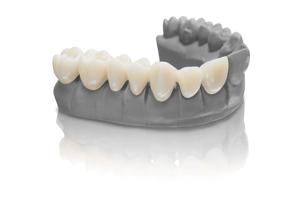 Das 3D-Druck-Material VarseoSmile Temp für temporäre Versorgungen ist ab sofort auch in BEGO Bleach erhältlich.