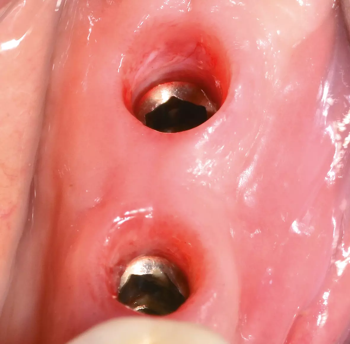 Abb. 13: Zustand nach Freilegung und Entfernung der Gingivaformer nach 10 Tagen.