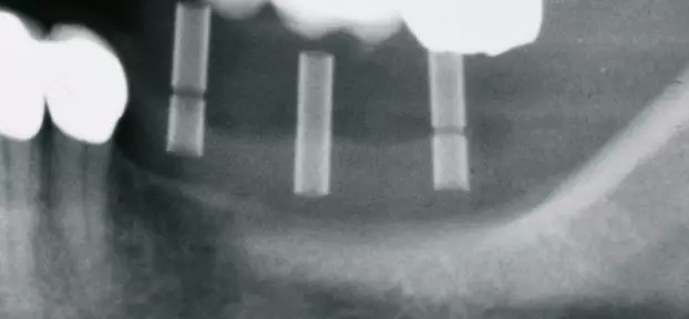 Abb. 17b: OPG mit geplanten Implantatpositionen vor Augmentation.