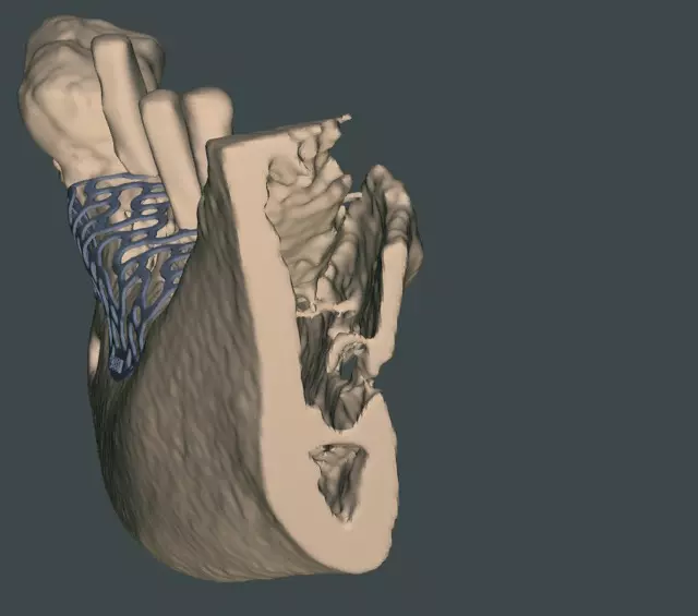 Abb. 17c: Digitale Planung des 3D-Titangitters.