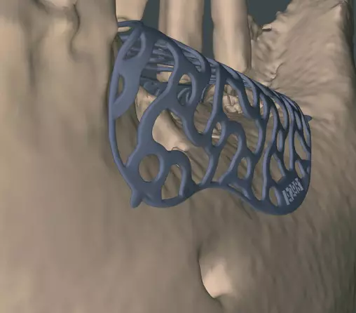 Abb. 17d: Digitale Planung des 3D-Titangitters.