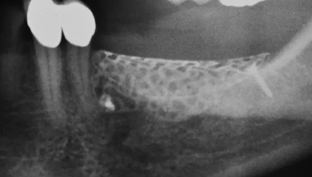 Abb. 24b: OPG nach Gitterimplantation.