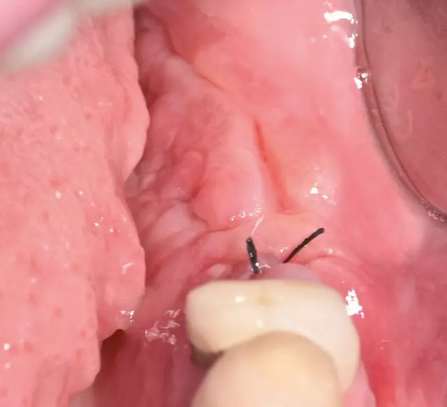 Abb. 26: 8 Tage post-OP nach Teilnahtentfernung und Belassen der tiefen Stabilisierungsnähte.