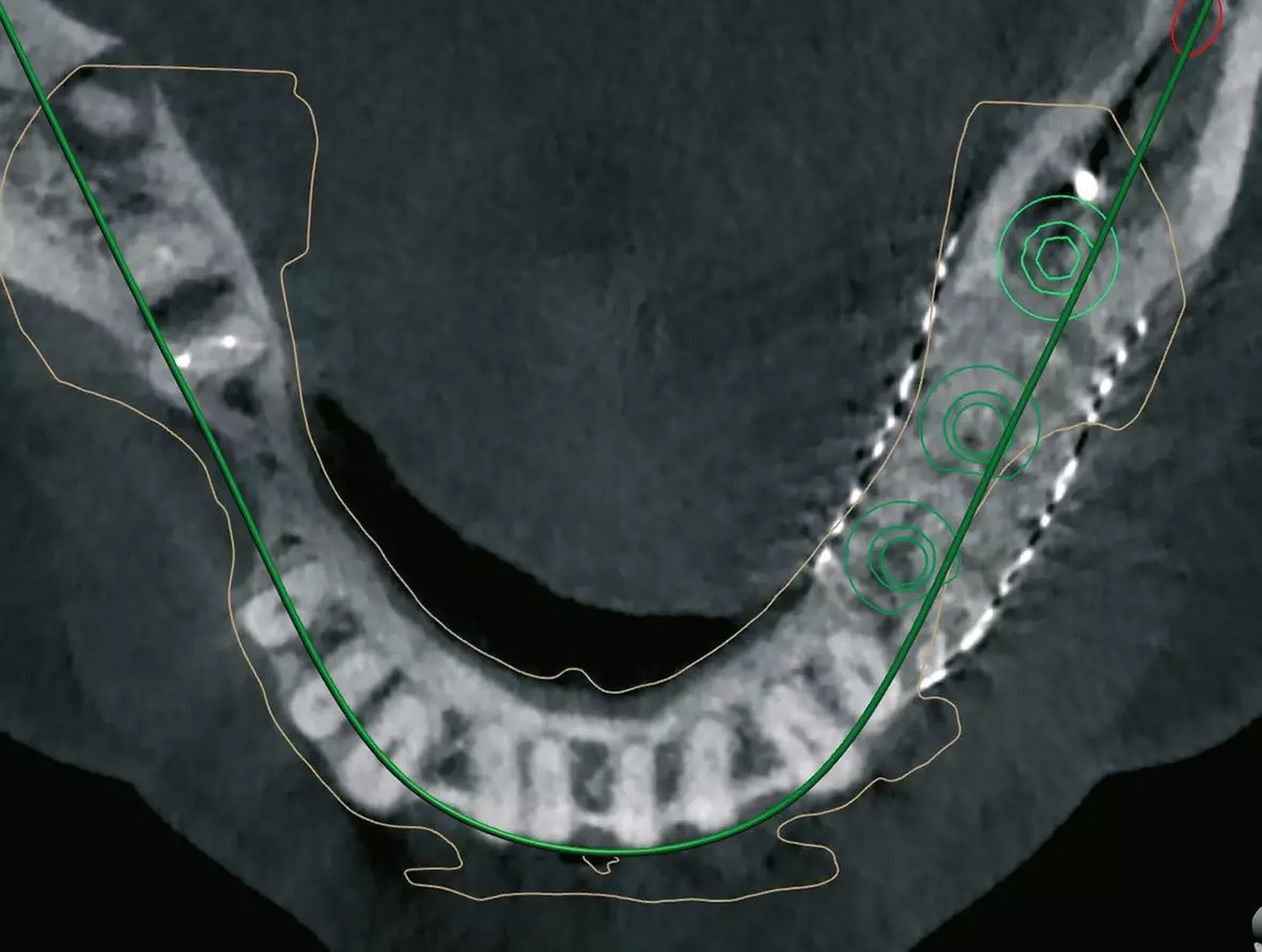 Abb. 27b: Implantatplanung für vollgeführte Implantation.