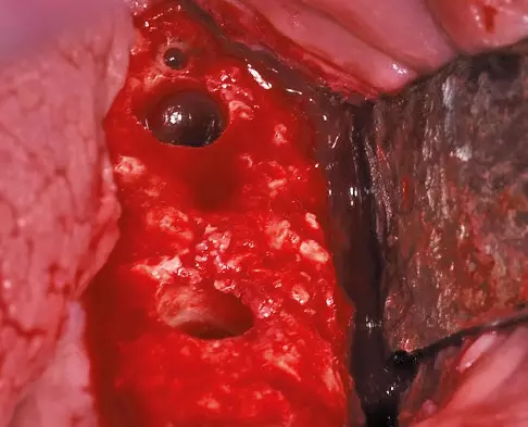 Abb. 30: Vorpräparierte Implantatlager (Achtung: mesial liegendes durch Zahnkrone verdeckt).