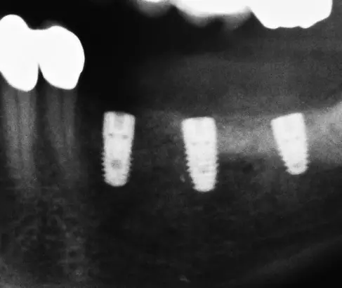 Abb. 34: Postoperatives OPG – Implantatposition wie geplant.
