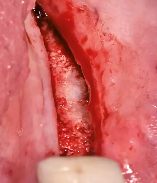 Abb. 35: Implantate liegen unter einer vitalen Knochenschicht.