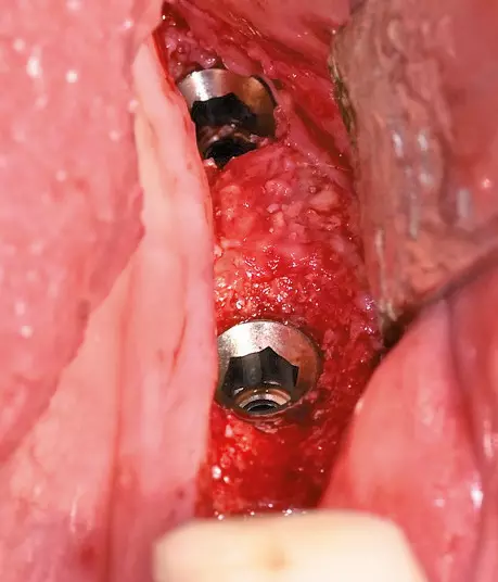 Abb. 36: Freigelegte Implantate nach Entfernung der Abdeckschrauben.