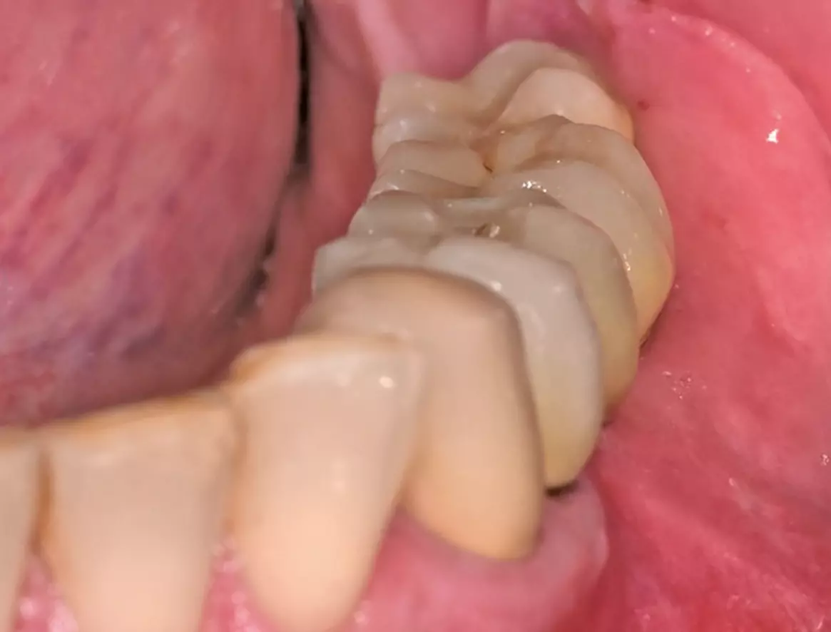 Abb. 39b: Eingegliederte prothetische Versorgung (Labor: Dentalwerk Nürnberg).