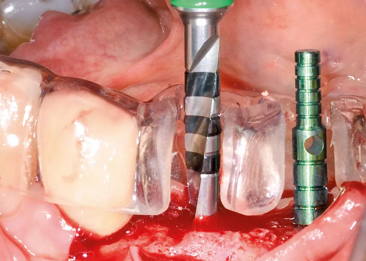 Abb. 5: Implantation nach 6 Monaten.