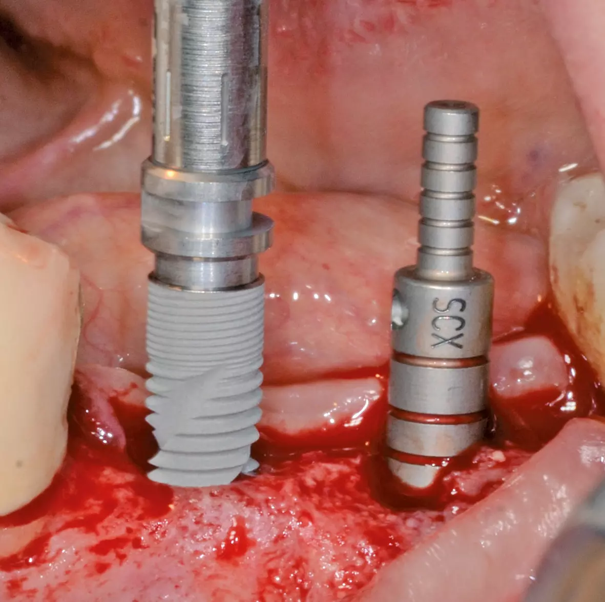 Abb. 6: Implantation nach 6 Monaten.