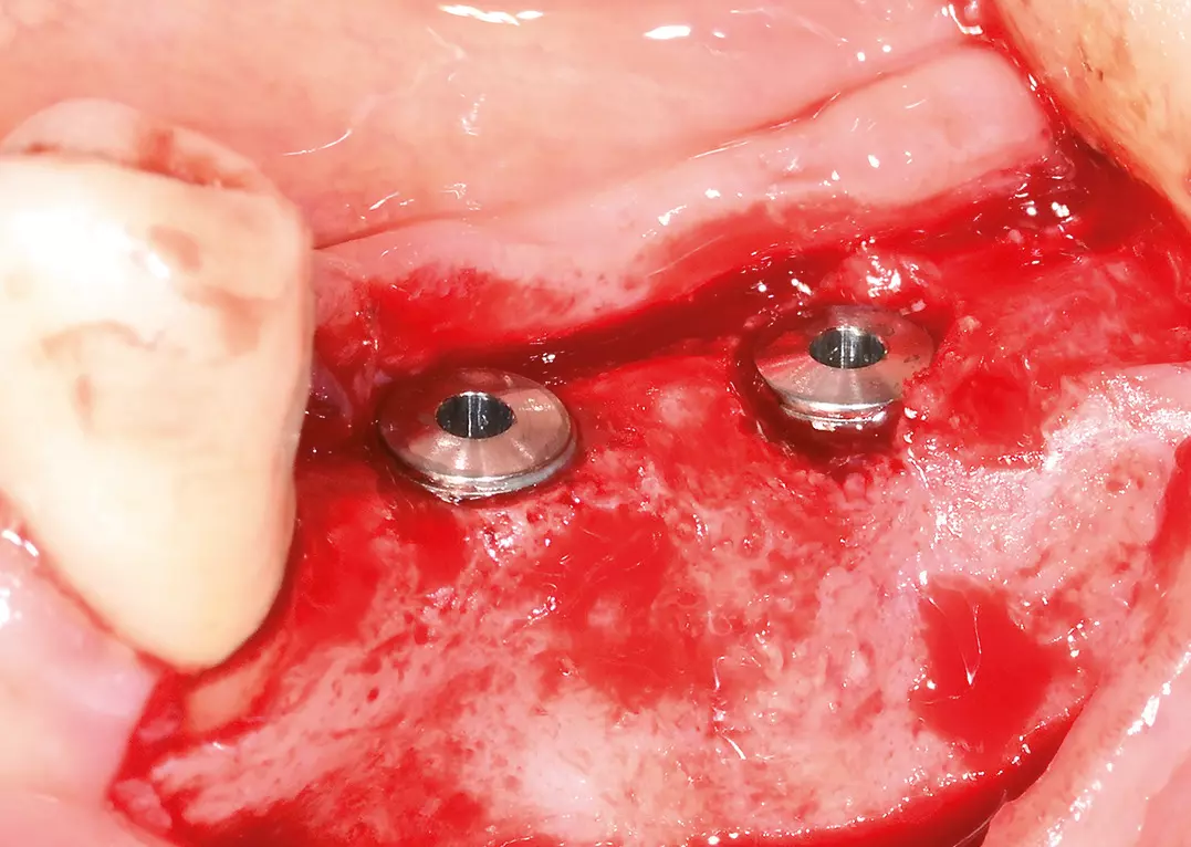 Abb. 7: Implantation nach 6 Monaten.