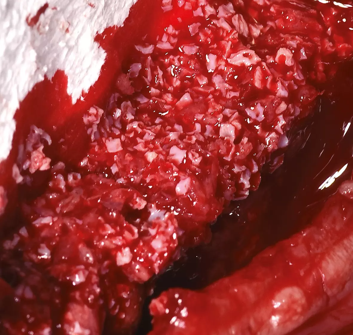 Abb. 8: Laterale und vertikale Nachkonturierung bei Implantation in GTR-Technik mit DBBM + Autogene Knochenchips (Bohrspäne) + PRF + Kollagenmembran.