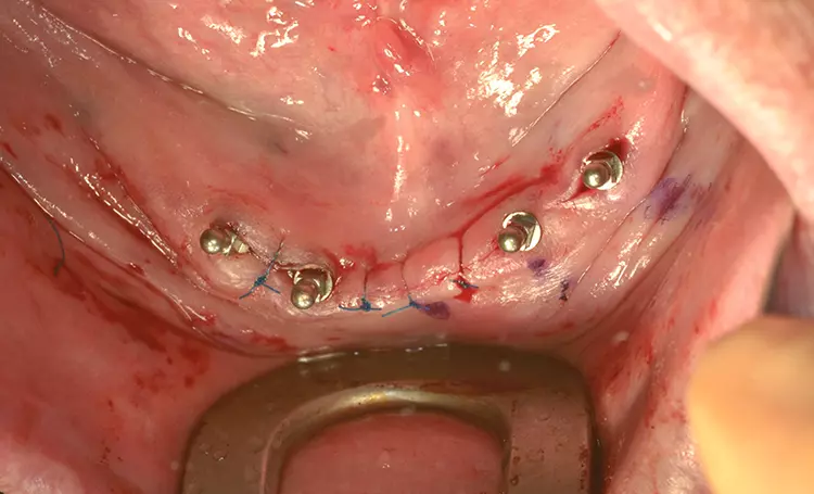 Abb. 2: Regio 32 und 34 wurden zwei Mini-Implantate (MDI, 3M, Seefeld) transgingival inseriert, während regio 42 und 44 das offene Vorgehen gewählt wurde. Sichtbar ist noch die Markierung der Implantatpositionen mittels Hautstift.