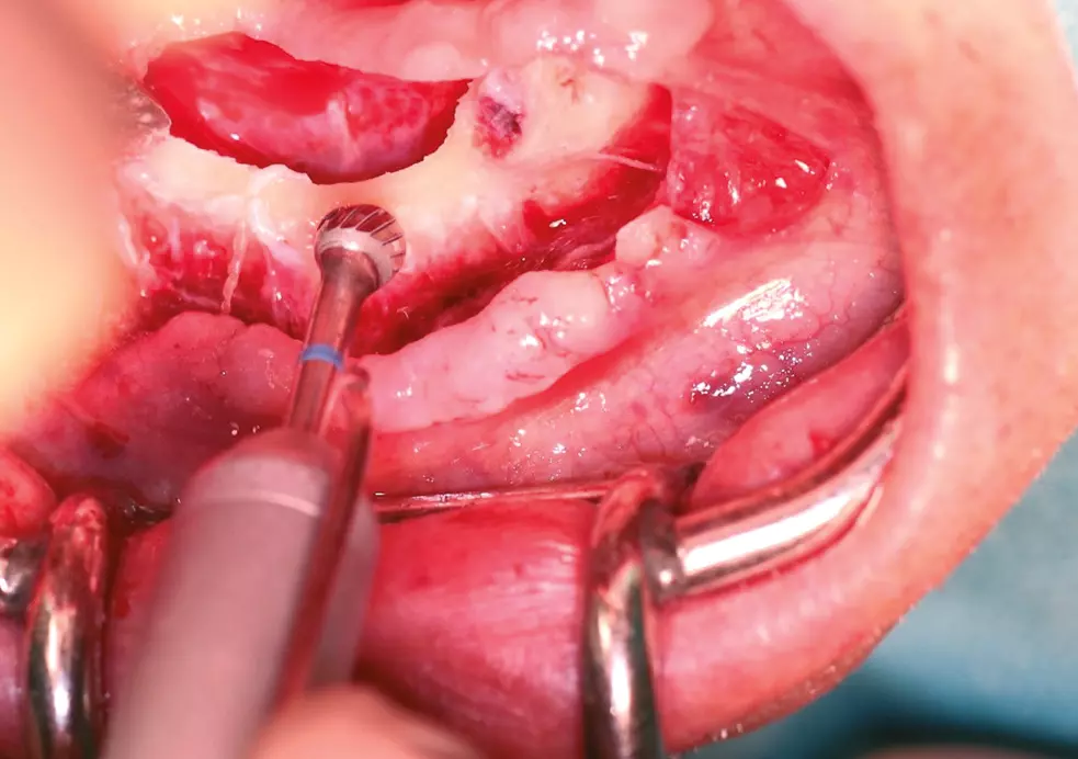 Abb. 3: Abtragen der krestalen Knochenkante mit Kugelfräse zur Verbreiterung des Implantatbettes im Bereich der Implantatschulter.