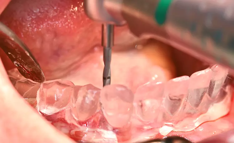 Abb. 4a und b: Schablonengestützte Markierung der interforaminären Implantatpositionen (mittels doublierter Unterkieferprothese).