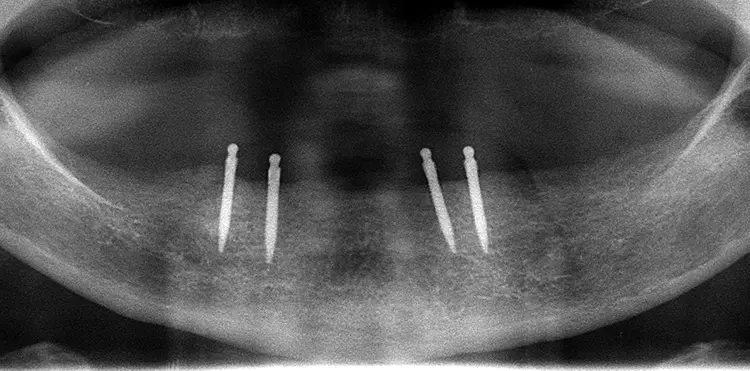 Abb. 7: Postoperative Kontrolle mittels Panoramaschichtaufnahme.