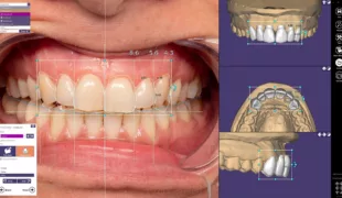 Ästhetikexperten in Praxen und Laboren werden sich freuen: exocad stellt auf der IDS die neue Softwaregeneration für Smile Design vor.