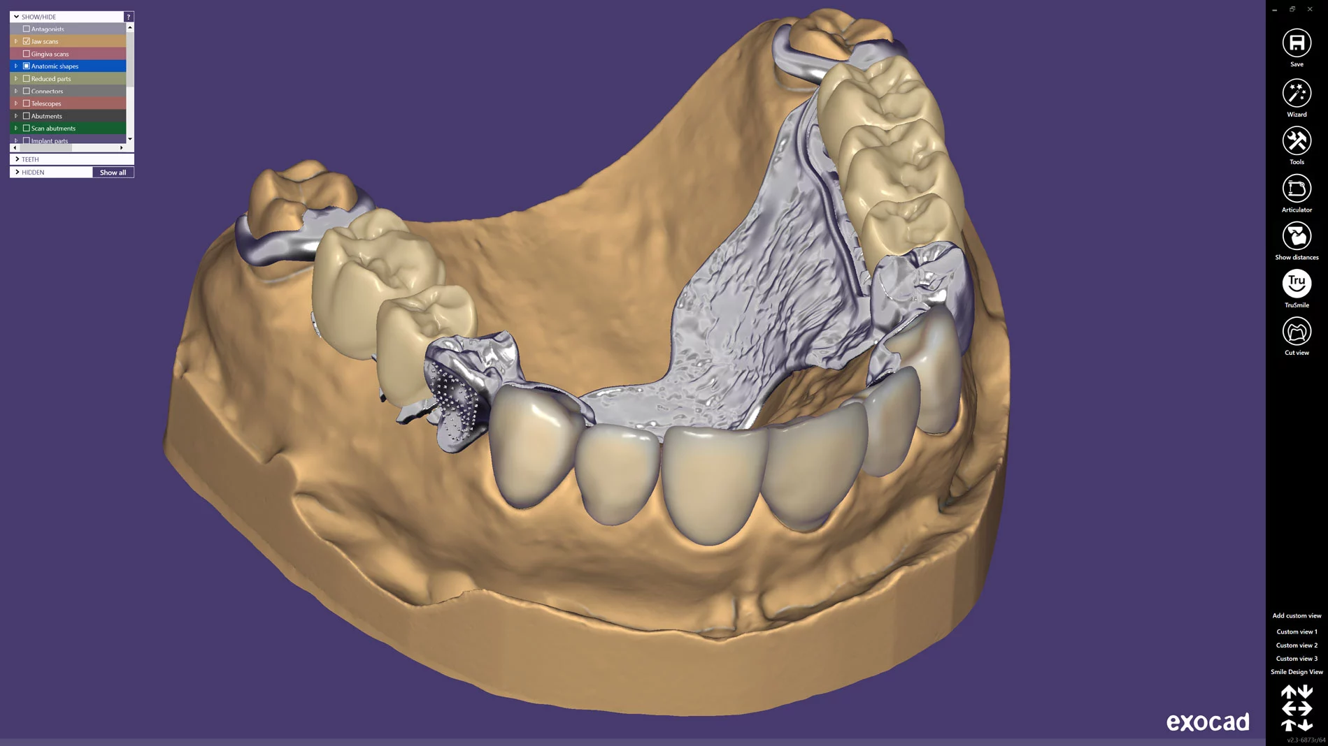Zur IDS präsentiert exocad das neue Release Dental CAD 2.3 Matera mit optimierten Features.