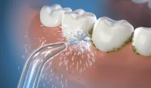 Im Vergleich zur Reinigung mit Zahnseide verbessert Waterpik® die Zahnfleischgesundheit effektiv bis zu 50%.