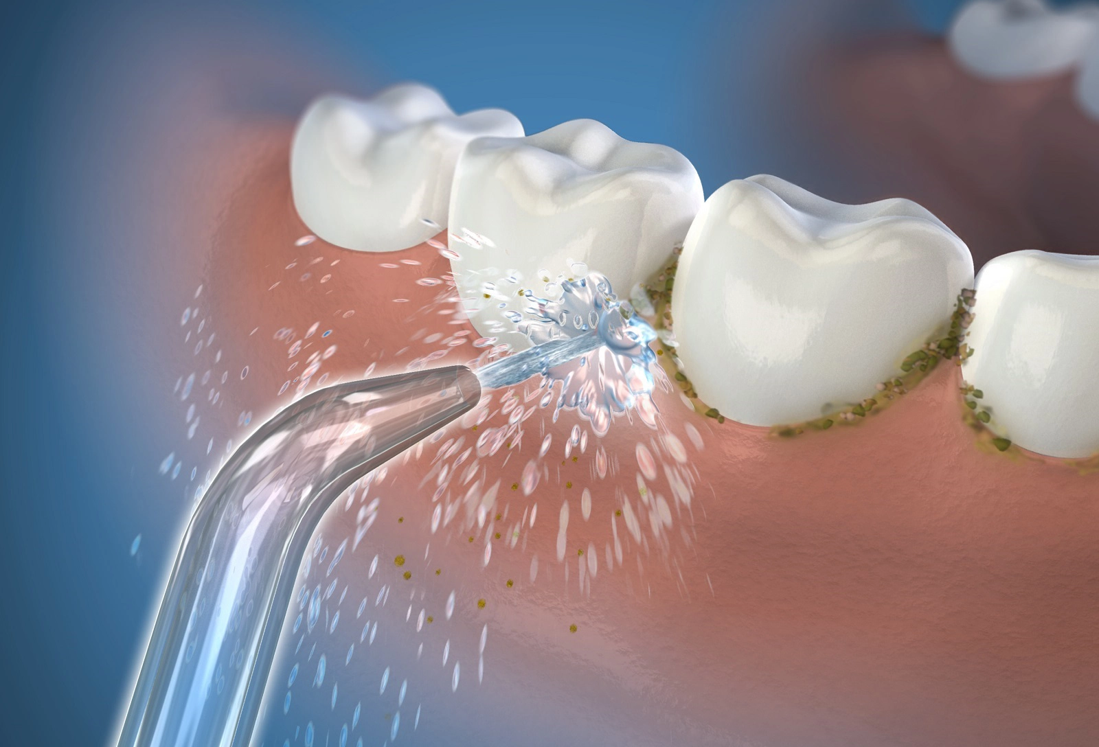 Im Vergleich zur Reinigung mit Zahnseide verbessert Waterpik® die Zahnfleischgesundheit effektiv bis zu 50%.