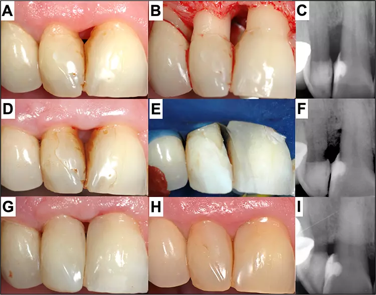 Abb. 11: Komplexe Rehabilitation eines schwarzen Dreiecks mit parodontalem Knochenverlust (A–C). Nach Chirurgie und GTR (2008) blieb nach der Heilung immer noch ein Weichgewebsdefekt (D/F). Dieser wurde mit entsprechender Matrizentechnik im gleichen Jahr mit Komposit aufgebaut (E/G). 13 Jahre nach Behandlung zeigt sich eine teilweise knöcherne Regeneration mit einem mit Weichgewebe gefüllten Interdentalraum (H/I). Der Abstand Knochen zu Kontaktpunkt wurde deutlich reduziert.