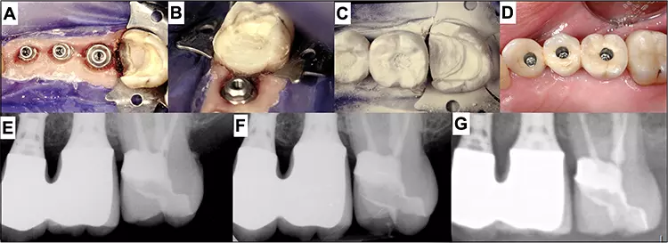 Abb. 2: Im Rahmen des Einsetzens der Implantatversorgung (2004) wurde eine insuffiziente Füllung beim wurzelbehandelten Zahn 27 entfernt (A) und eine Stufenhebung durchgeführt (B), um in diesem Fall die optische Abdrucknahme zu erleichtern (C: Status nach Puderung). Bild D zeigt das frisch zementierte Keramik-Overlay. Die Röntgenbilder E bis G zeigen die stabile Situation in den Jahren 2004, 2008 und 2018 (Letzteres OPT-Ausschnitt).