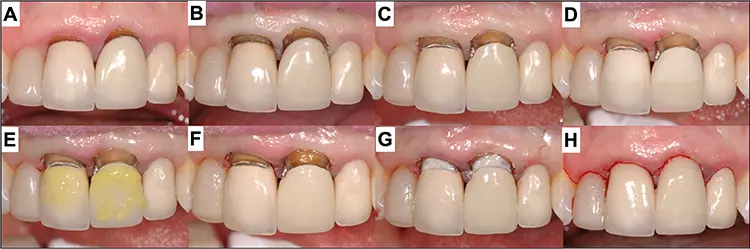 Abb. 4: Reparatur einer leichten Rezession bei den zentralen Oberkiefer-Inzisiven (A): Zuerst wurden Retraktionsfäden gelegt (B) und die Kavität und die Ränder präpariert (C). Nach dem Sandstrahlen (D) wurde die Keramik mit Flusssäure geätzt (E) und die Oberflächen adhäsiv vorbereitet (F). Das Metall und die dunklen Wurzeln wurden mit einer Malfarbe unterlegt (G). Bild H: Zustand nach Politur.