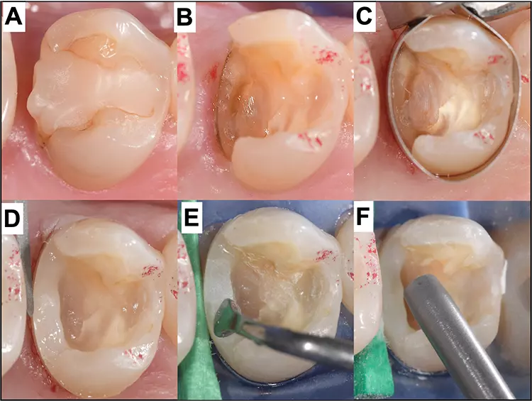 Abb. 1: Stufenhebung Schritt für Schritt: Ausgangssituation (A), Status nach Entfernung der insuffizienten Kompositfüllung und Exkavation mit subgingival liegender Dentinstufe (B), Legen einer zirkulären abdichtenden Metallmatrize (C), Status nach Legen des 1. Inkrements und Finieren mit einer EVA-Feile (D), Nachfinieren mit einer oszillierenden Feile (E) und mechanisches Anfrischen der Kompositstufe mit Sandstrahlen für die nachfolgenden Adhäsivschritte inklusive Silanisieren (F). Im Anschluss daran kann die Restauration wie üblich mit einer Halbmatrize morphologisch korrekt gestaltet werden.