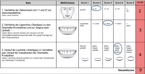 Abb. 2c: Zur Bestimmung des Scores (Item 1) wurde der Winkel der
Zahnachsen 11 und 21 zur Gesichtsmittellinie mithilfe eines Geodreiecks bestimmt und eine leichte
Abweichung (5°) bzw. Score 2 festgestellt.
Item 2 erfasst den durchschnittlichen Verlauf der Lippenlinie zu den Oberkieferfrontzähnen und zur Gingiva
beim Lächeln. Hier konnte mithilfe einer Dental-Schieblehre (Zürcher Modell) eine tiefe Lippenlinie mit
Abweichung von ca. 4 mm vom Ideal festgestellt werden.
Bei der Bestimmung von Item 3 sollte die Lachlinie (Verlauf der Unterlippe beim Lächeln) im Idealfall dem
Verlauf des Zahnbogens bzw. dem Verlauf der Inzisalkanten der Oberkieferfrontzähne folgen. Hier wurde
aufgrund des leicht konkaven Zahnbogens eine umgekehrte (negative) Lachlinie bzw. Score 4 festgestellt.
c. Die Erhebung des extraoralen DASI-Scores vor der restaurativen Therapie ergab mit einem Wert von 9 eine
befriedigende extraorale Ästhetik.